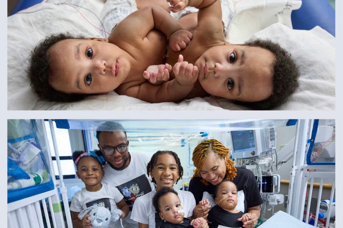 Conjoined twins are successfully separated at Philadelphia hospital, ready to sleep in their own beds [Video]