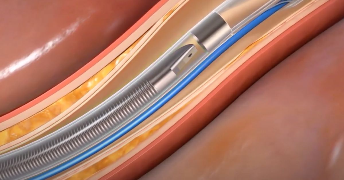 Conavi Medical Unveils Next-Gen Dual-Modality Catheter for Cardiac Interventions [Video]