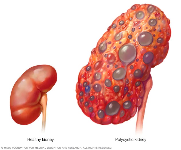 Rising Kidney Disease in Young Adults [Video]