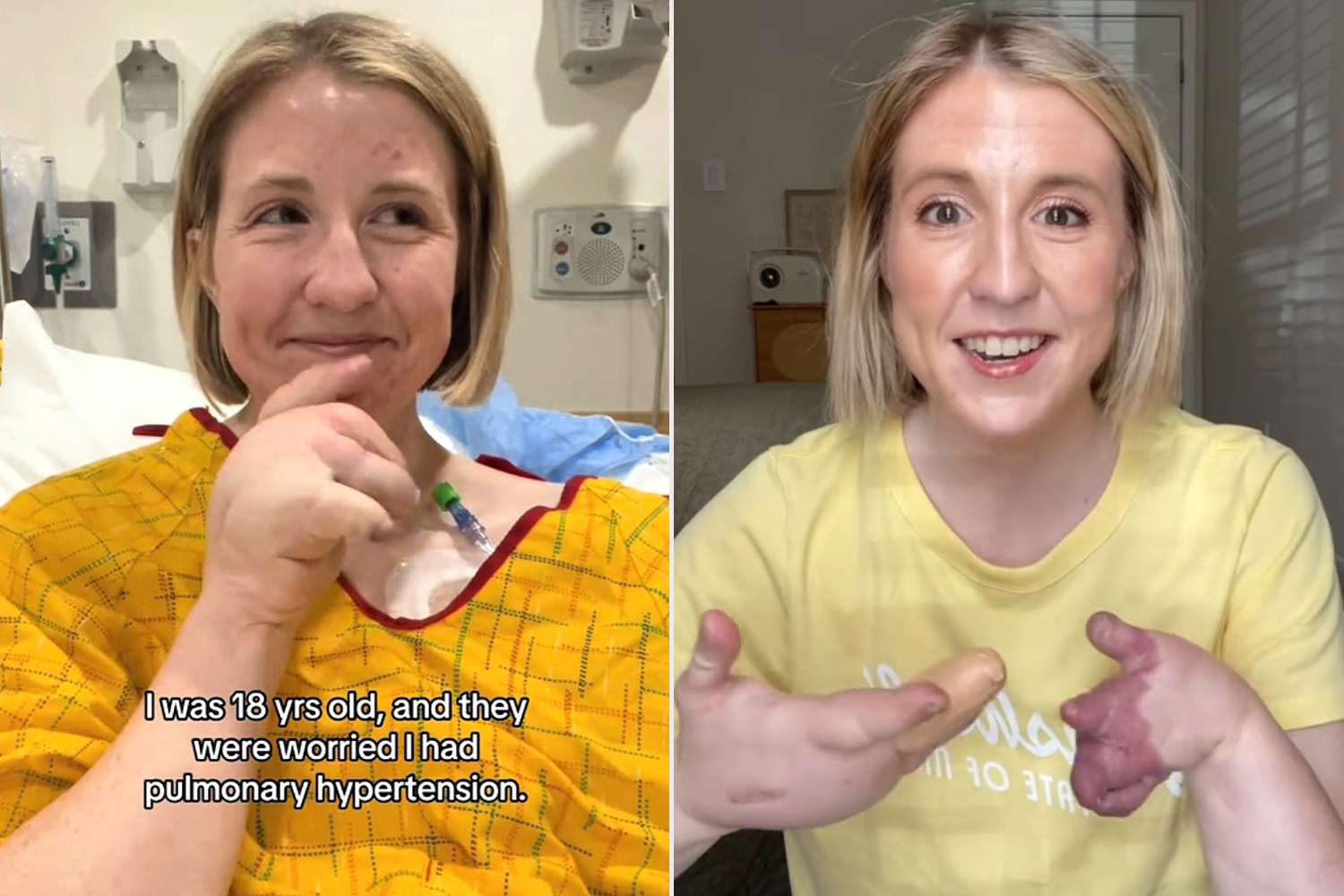 Woman Living with CLOVES Syndrome Documents Life (Exclusive) [Video]